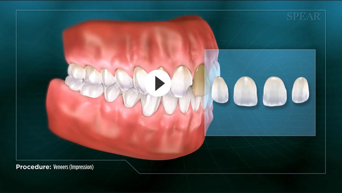 Veneers Thumbnail