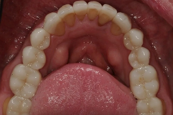 Mercury-Free Dentistry Before and Afters at Suite Dental