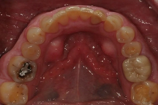 Mercury-Free Dentistry Before and Afters at Suite Dental